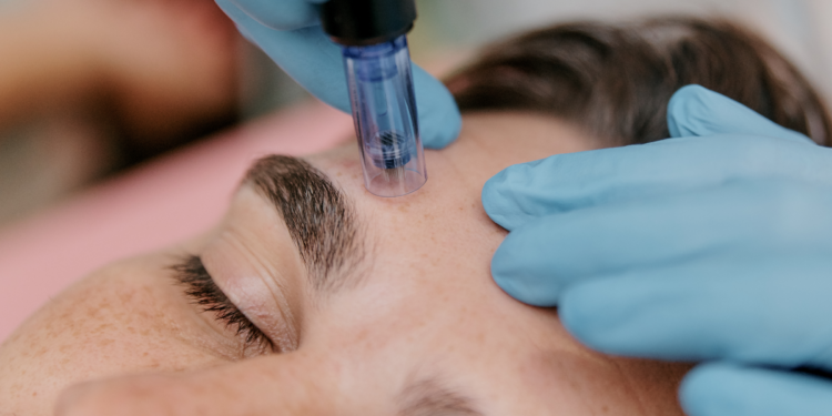 Close-up of a person receiving a microneedling treatment on the forehead from a practitioner wearing blue gloves.