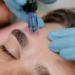 Close-up of a person receiving a microneedling treatment on the forehead from a practitioner wearing blue gloves.